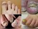 Лечение грибка ногтей и кожи на ногах в запущенной форме Как вылечить грибок на ногтях запущенный