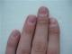 Пустота под ногтями (онихолизис): причины появления, лечение, фото Как излечить гнойные выделения у ногтей рук